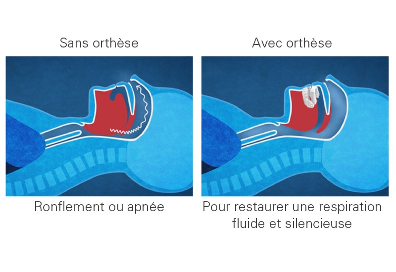 Traitement par OAM - Syndrome Apnées du Sommeil